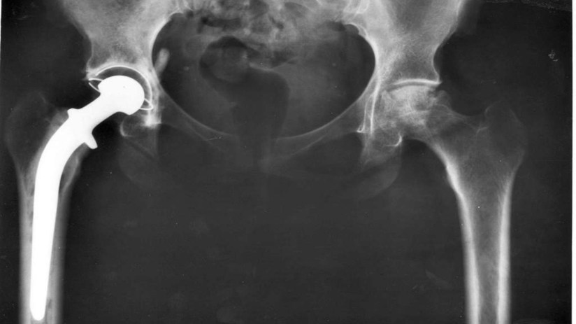 Smith & Nephew is one of the world's largest hip replacement manufacturers